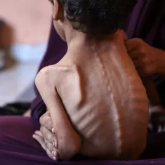 تصویر یک کودک لاغر و آسیب‌پذیر را نشان می‌دهد که در آغوش یک زن نشسته است.