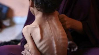 تصویر یک کودک لاغر و آسیب‌پذیر را نشان می‌دهد که در آغوش یک زن نشسته است.